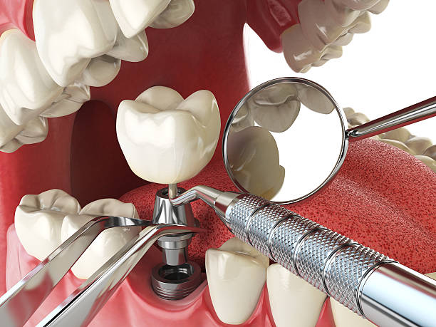 Best Knocked-Out Tooth (Avulsed Tooth) Treatment in Davenport, FL